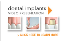 dental implant videos