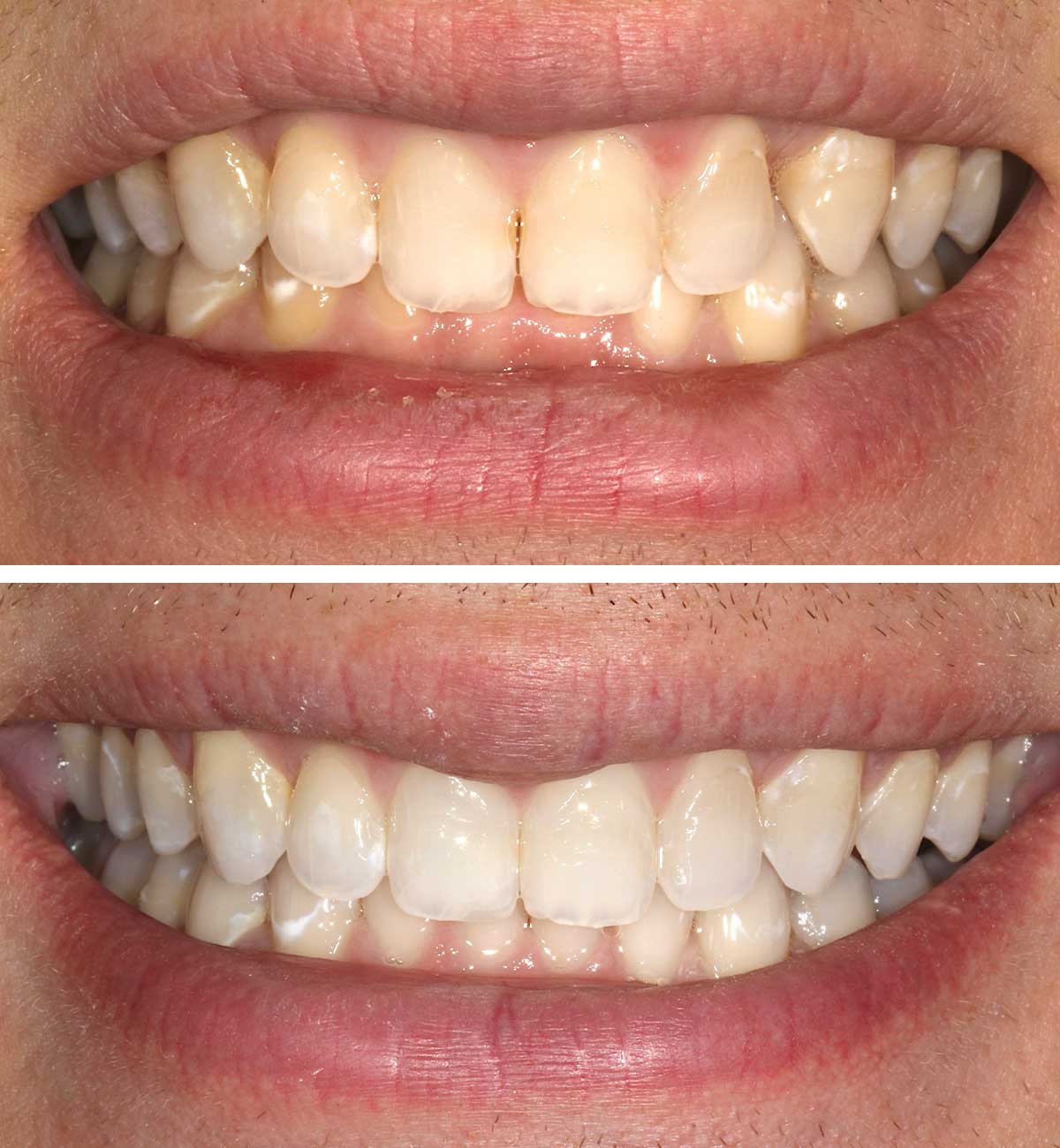 Overbite