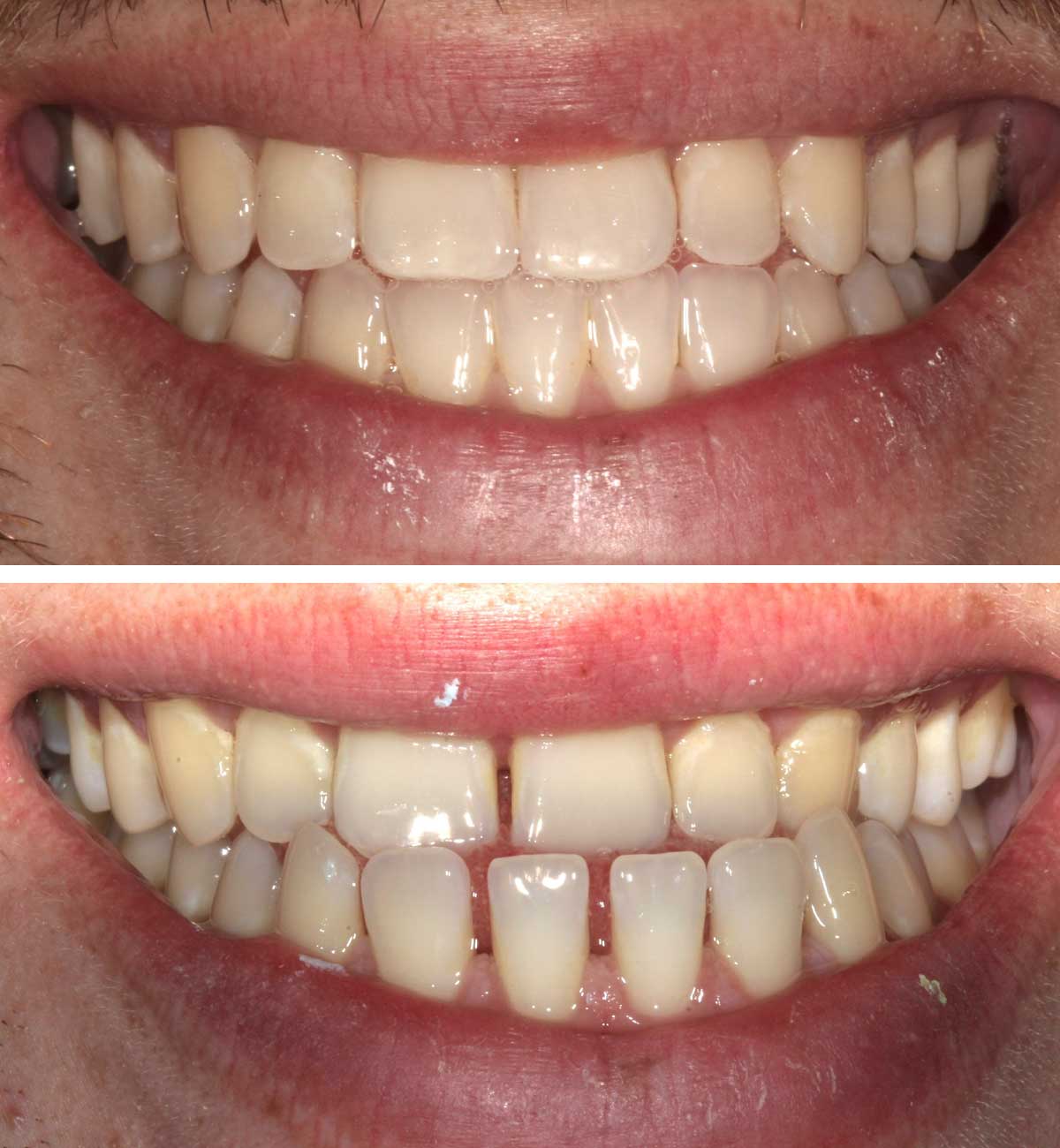 Underbite