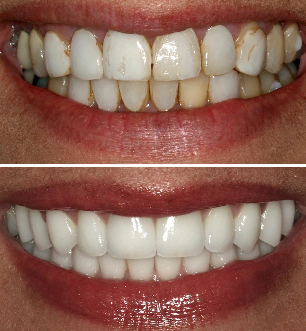 Replace Veneers